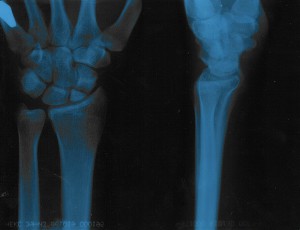 bone_fracture